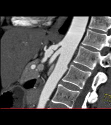 Celiac Artery Aneurysm - CTisus CT Scan