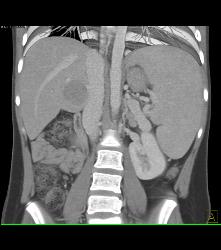 Hepatocellular Carcinoma (Hepatoma) in Cirrhotic Liver- Nonvascular - CTisus CT Scan