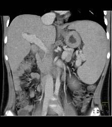 Hepatocellular Carcinoma (Hepatoma) in Cirrhotic Liver- Nonvascular - CTisus CT Scan