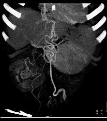 Varices With Recanalized Umbilical Vein - CTisus CT Scan