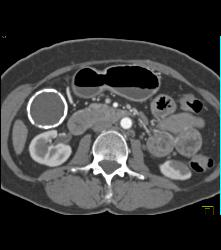 Porcelain Gallbladder - CTisus CT Scan