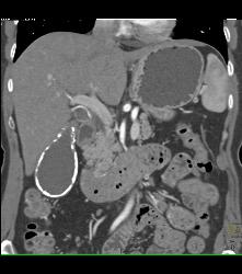 Porcelain Gallbladder - CTisus CT Scan