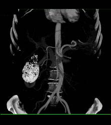 Porcelain Gallbladder - CTisus CT Scan