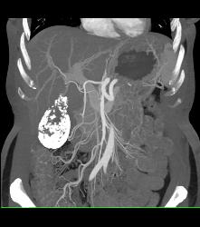 Porcelain Gallbladder - CTisus CT Scan