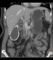 Porcelain Gallbladder - CTisus CT Scan