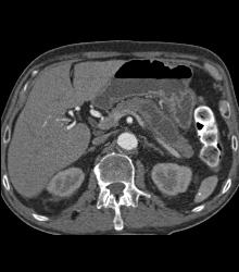 Pancreatic Cancer With Dilated Duct Which Was Central Intraductal Papillary Mucinous Neoplasm (IPMN). No Liver Involvement - CTisus CT Scan