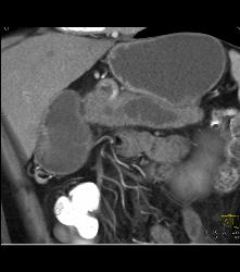 Pancreatic Cancer With Dilated Duct Which Was Central Intraductal Papillary Mucinous Neoplasm (IPMN). No Liver Involvement - CTisus CT Scan