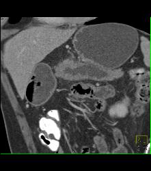 Pancreatic Cancer With Dilated Duct Which Was Central Intraductal Papillary Mucinous Neoplasm (IPMN). No Liver Involvement - CTisus CT Scan