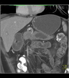 Pancreatic Cancer With Dilated Duct Which Was Central Intraductal Papillary Mucinous Neoplasm (IPMN). No Liver Involvement - CTisus CT Scan