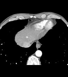 Hemangioma That Is Flash Filling - CTisus CT Scan