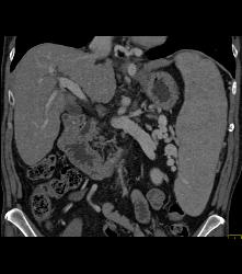 Cirrhosis With Portal Hypertension and Huge Varices - CTisus CT Scan