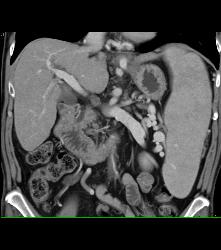 Cirrhosis With Portal Hypertension and Huge Varices - CTisus CT Scan