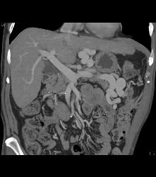 Cirrhosis With Portal Hypertension and Huge Varices - CTisus CT Scan