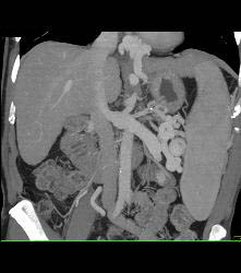 Cirrhosis With Portal Hypertension and Huge Varices - CTisus CT Scan