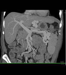 Cirrhosis With Portal Hypertension and Huge Varices - CTisus CT Scan