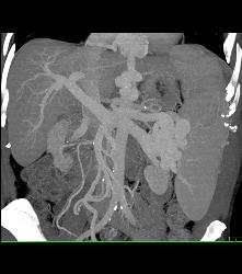 Cirrhosis With Portal Hypertension and Huge Varices - CTisus CT Scan