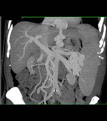 Cirrhosis With Portal Hypertension and Huge Varices - CTisus CT Scan