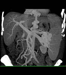 Cirrhosis With Portal Hypertension and Huge Varices - CTisus CT Scan