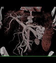 Cirrhosis With Portal Hypertension and Huge Varices - CTisus CT Scan