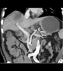 Hepatocellular Carcinoma (Hepatoma) in A Cirrhotic Liver. Nodes Also Seen - CTisus CT Scan