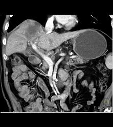 Hepatocellular Carcinoma (Hepatoma) in A Cirrhotic Liver. Nodes Also Seen - CTisus CT Scan