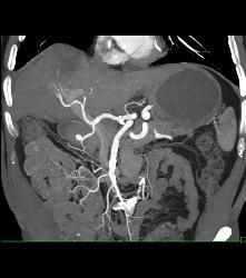 Hepatocellular Carcinoma (Hepatoma) in A Cirrhotic Liver. Nodes Also Seen - CTisus CT Scan