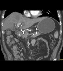 Hepatocellular Carcinoma (Hepatoma) in A Cirrhotic Liver. Nodes Also Seen - CTisus CT Scan