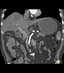 Hepatocellular Carcinoma (Hepatoma) in A Cirrhotic Liver. Nodes Also Seen - CTisus CT Scan