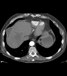 Hepatocellular Carcinoma (Hepatoma) in A Cirrhotic Liver. Nodes Also Seen - CTisus CT Scan