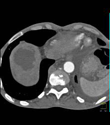 Hepatocellular Carcinoma (Hepatoma) in A Cirrhotic Liver. Nodes Also Seen - CTisus CT Scan