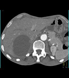 Necrotic Hepatocellular Carcinoma (Hepatoma) - CTisus CT Scan