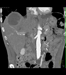 Necrotic Hepatocellular Carcinoma (Hepatoma) - CTisus CT Scan