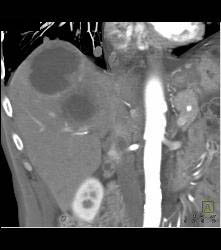 Necrotic Hepatocellular Carcinoma (Hepatoma) - CTisus CT Scan