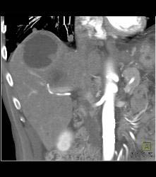 Necrotic Hepatocellular Carcinoma (Hepatoma) - CTisus CT Scan