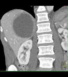 Necrotic Hepatocellular Carcinoma (Hepatoma) - CTisus CT Scan