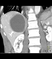 Necrotic Hepatocellular Carcinoma (Hepatoma) - CTisus CT Scan