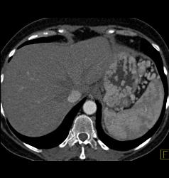 Islet Cell Tumor of the Pancreas With Arterial Collaterals and Tumor Invasion of Portal Vein With Huge Collaterals - CTisus CT Scan