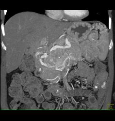 Islet Cell Tumor of the Pancreas With Arterial Collaterals and Tumor Invasion of Portal Vein With Huge Collaterals - CTisus CT Scan