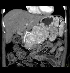 Islet Cell Tumor of the Pancreas With Arterial Collaterals and Tumor Invasion of Portal Vein With Huge Collaterals - CTisus CT Scan