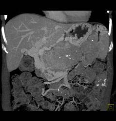 Islet Cell Tumor of the Pancreas With Arterial Collaterals and Tumor Invasion of Portal Vein With Huge Collaterals - CTisus CT Scan