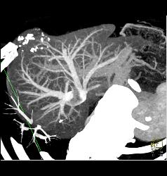 Normal Hepatic Veins - CTisus CT Scan