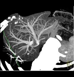 Normal Hepatic Veins - CTisus CT Scan