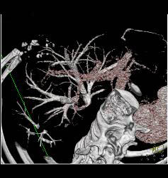 Normal Hepatic Veins - CTisus CT Scan