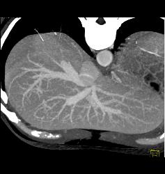 Normal Hepatic Veins - CTisus CT Scan