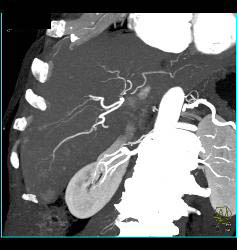 Metastatic Islet Cell Tumor- Subtle - CTisus CT Scan