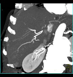 Metastatic Islet Cell Tumor- Subtle - CTisus CT Scan