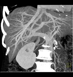 Metastatic Islet Cell Tumor- Subtle - CTisus CT Scan