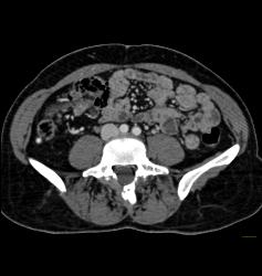 Tumor Implant on Surface of the Liver - CTisus CT Scan