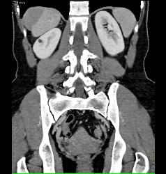 Tumor Implant on Surface of the Liver - CTisus CT Scan