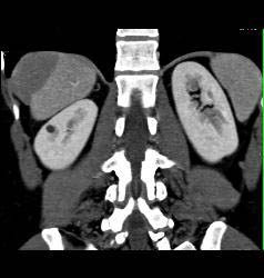 Tumor Implant on Surface of the Liver - CTisus CT Scan